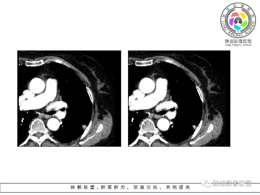 【病例】小征象大用途---脐凹征 【病例】小征象大用途---脐凹征