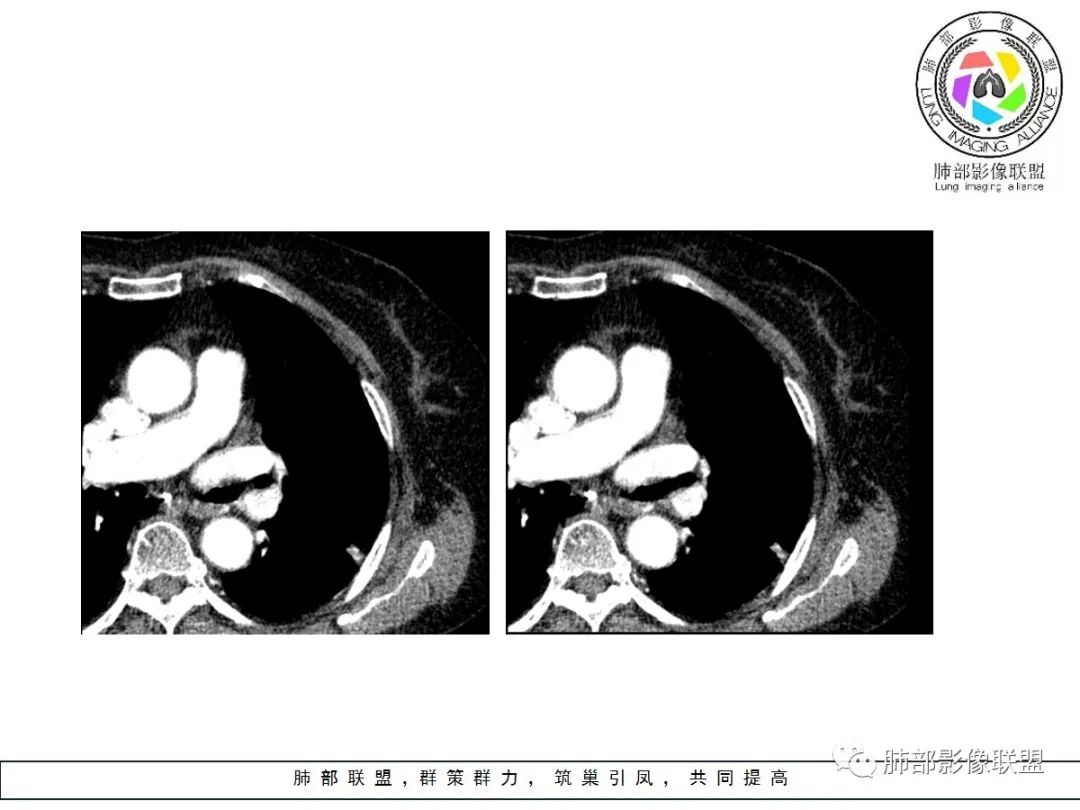 【病例】小征象大用途---脐凹征 【病例】小征象大用途---脐凹征
