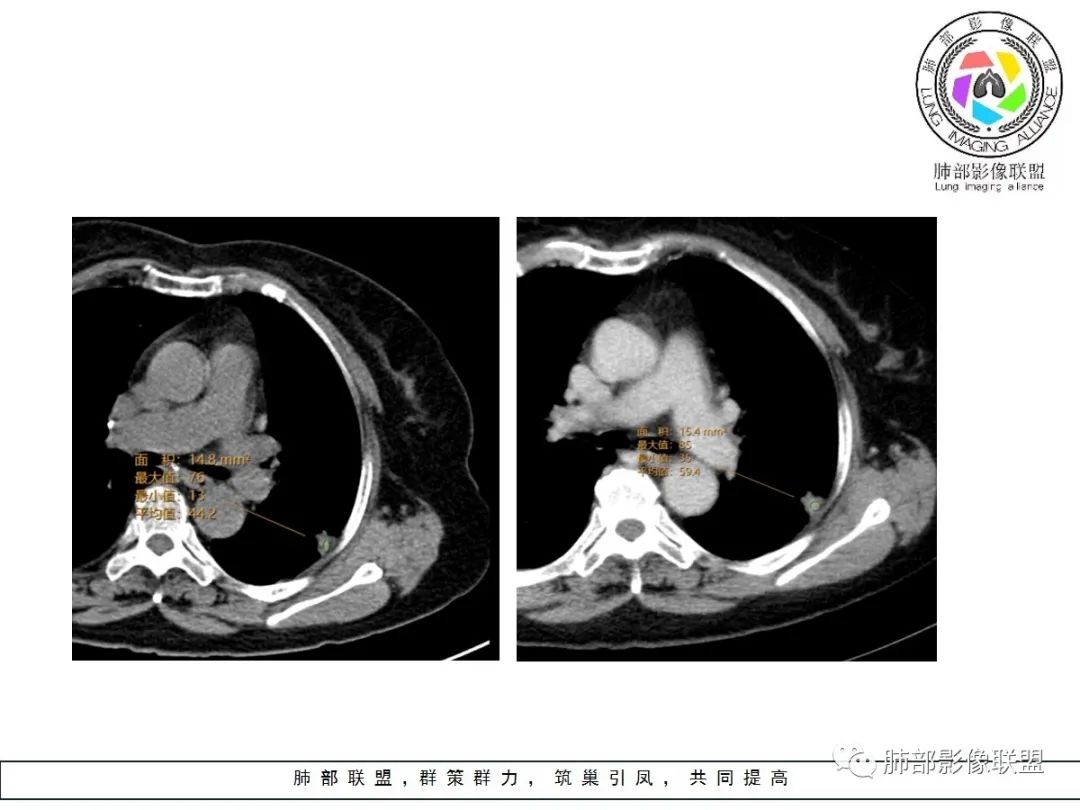 【病例】小征象大用途---脐凹征 【病例】小征象大用途---脐凹征