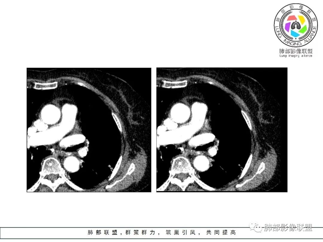 【病例】小征象大用途---脐凹征 【病例】小征象大用途---脐凹征