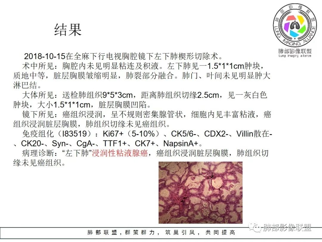 【病例】小征象大用途---脐凹征 【病例】小征象大用途---脐凹征
