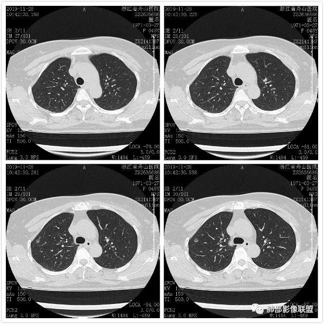 【病例】空泡和胸膜牵拉的价值你清楚吗? 【病例】空泡和胸膜牵拉的价值你清楚吗?
