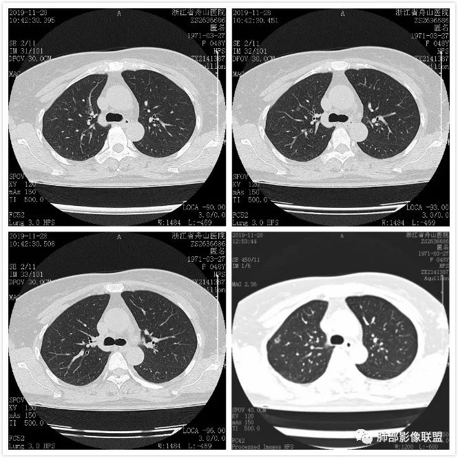 【病例】空泡和胸膜牵拉的价值你清楚吗? 【病例】空泡和胸膜牵拉的价值你清楚吗?