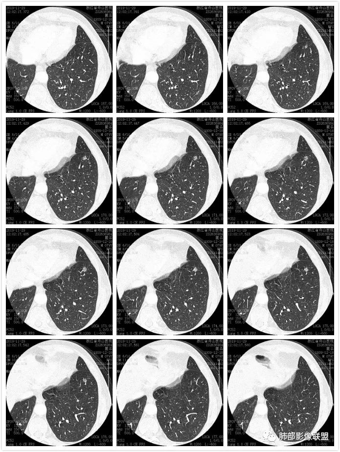 【病例】空泡和胸膜牵拉的价值你清楚吗? 【病例】空泡和胸膜牵拉的价值你清楚吗?