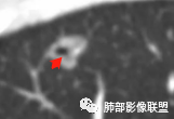 【病例】空泡和胸膜牵拉的价值你清楚吗? 【病例】空泡和胸膜牵拉的价值你清楚吗?