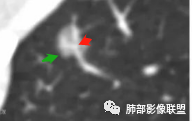 【病例】空泡和胸膜牵拉的价值你清楚吗? 【病例】空泡和胸膜牵拉的价值你清楚吗?