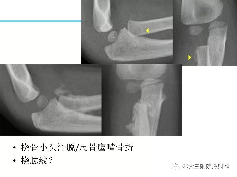【PPT】儿童肘关节骨折的X线表现