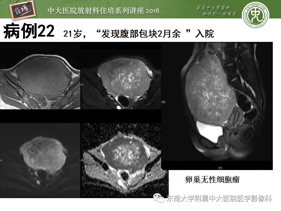 【PPT】卵巢占位诊断与鉴别