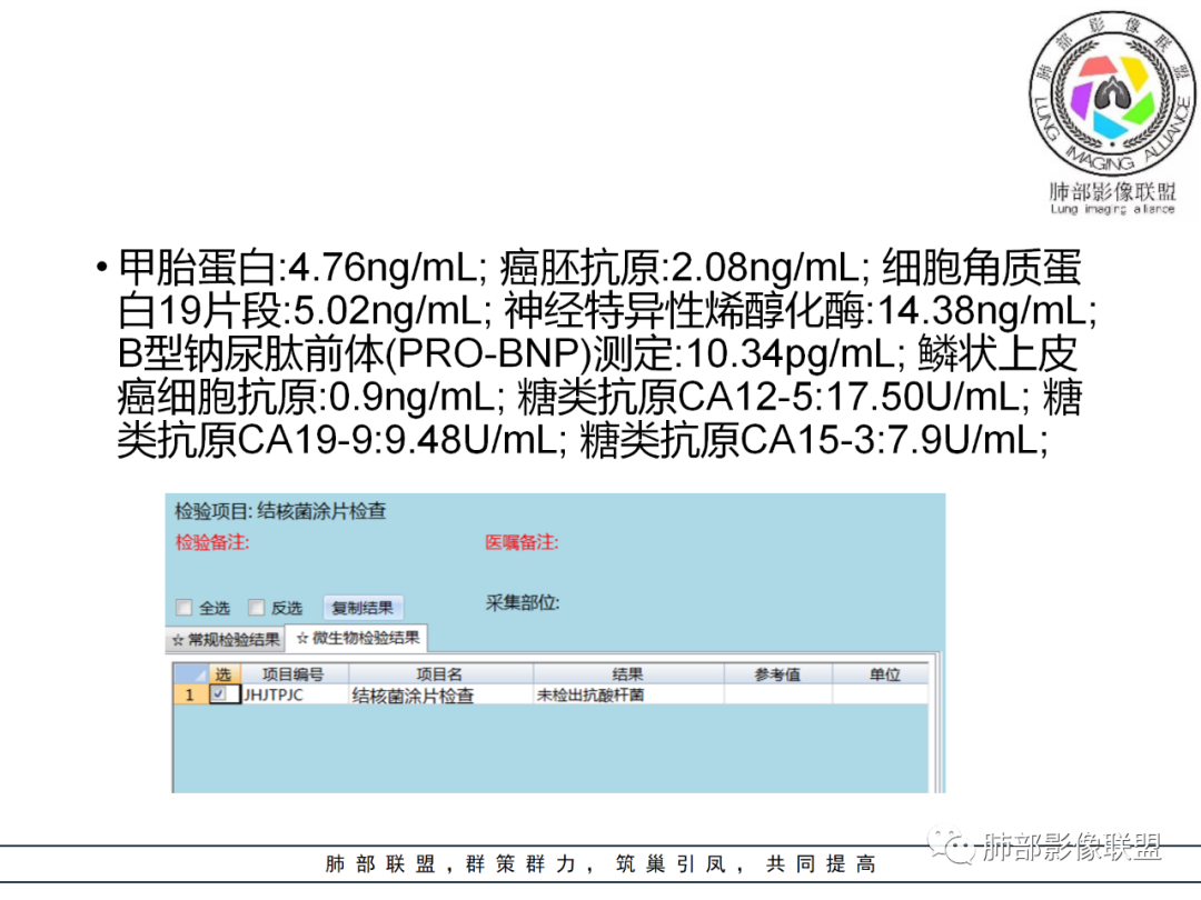 【病例】易误诊的肺结核1例CT影像讨论 【病例】易误诊的肺结核1例CT影像讨论