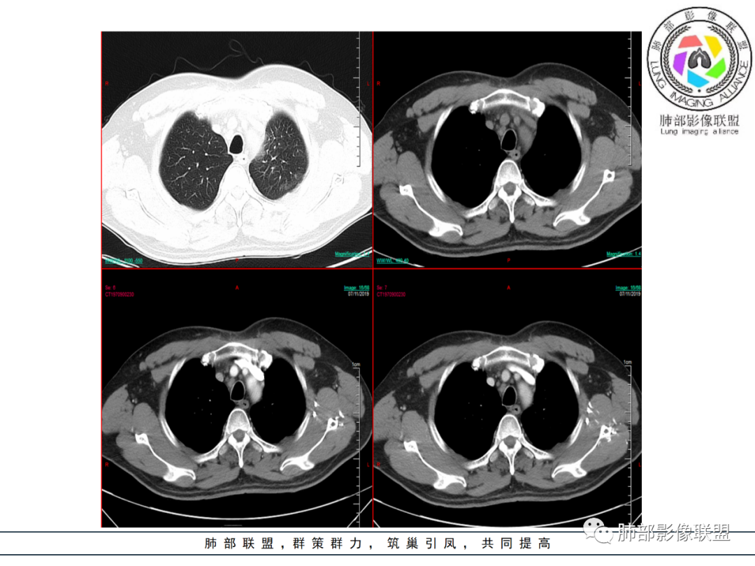 【病例】易误诊的肺结核1例CT影像讨论 【病例】易误诊的肺结核1例CT影像讨论