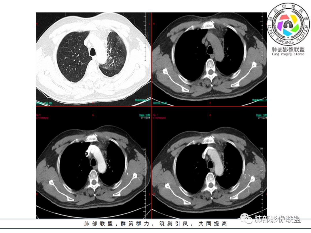 【病例】易误诊的肺结核1例CT影像讨论 【病例】易误诊的肺结核1例CT影像讨论