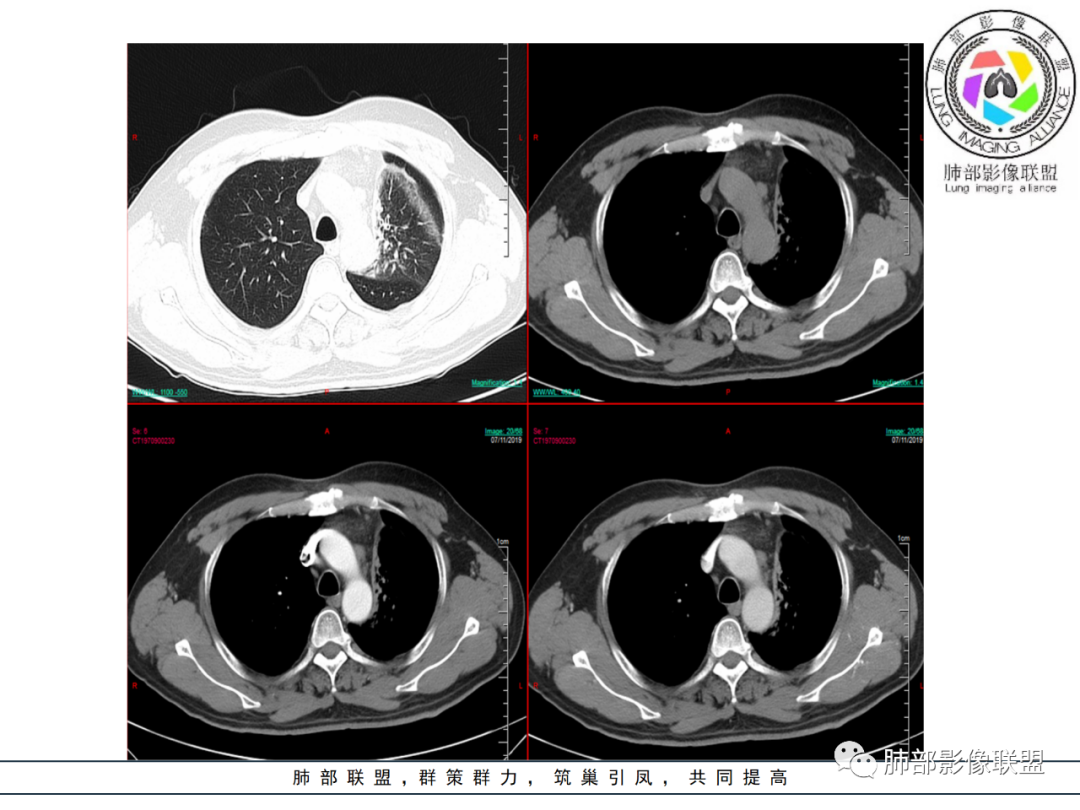 【病例】易误诊的肺结核1例CT影像讨论 【病例】易误诊的肺结核1例CT影像讨论