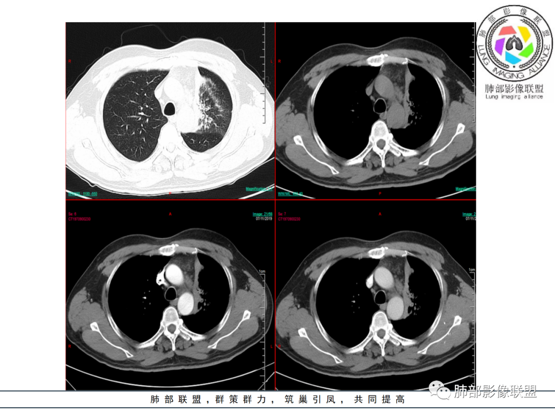 【病例】易误诊的肺结核1例CT影像讨论 【病例】易误诊的肺结核1例CT影像讨论