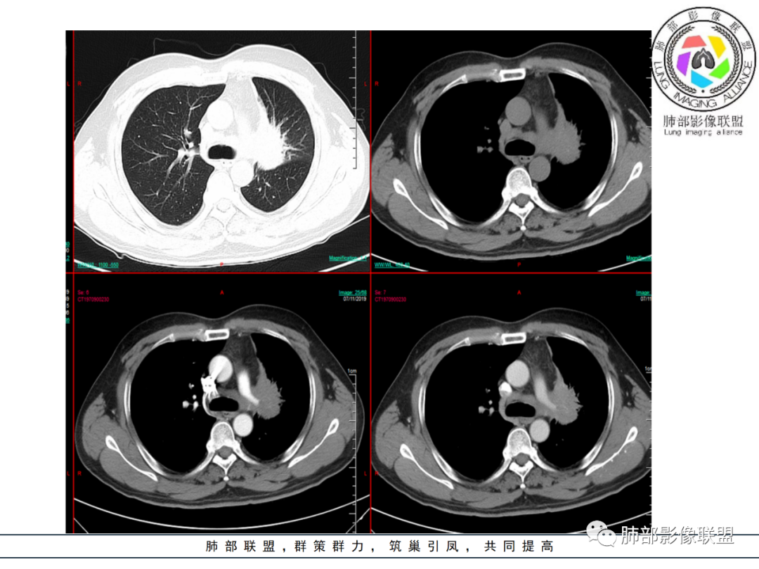 【病例】易误诊的肺结核1例CT影像讨论 【病例】易误诊的肺结核1例CT影像讨论
