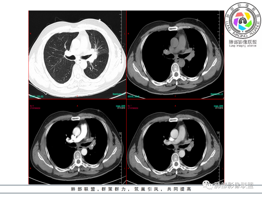 【病例】易误诊的肺结核1例CT影像讨论 【病例】易误诊的肺结核1例CT影像讨论