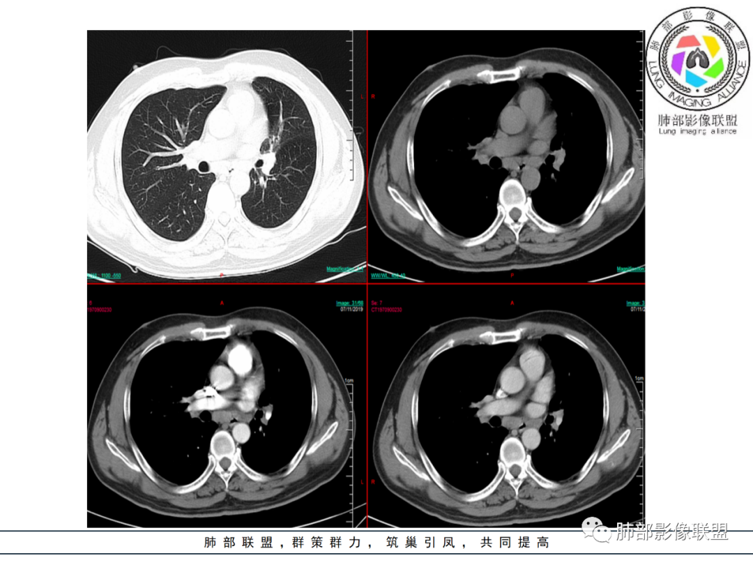 【病例】易误诊的肺结核1例CT影像讨论 【病例】易误诊的肺结核1例CT影像讨论