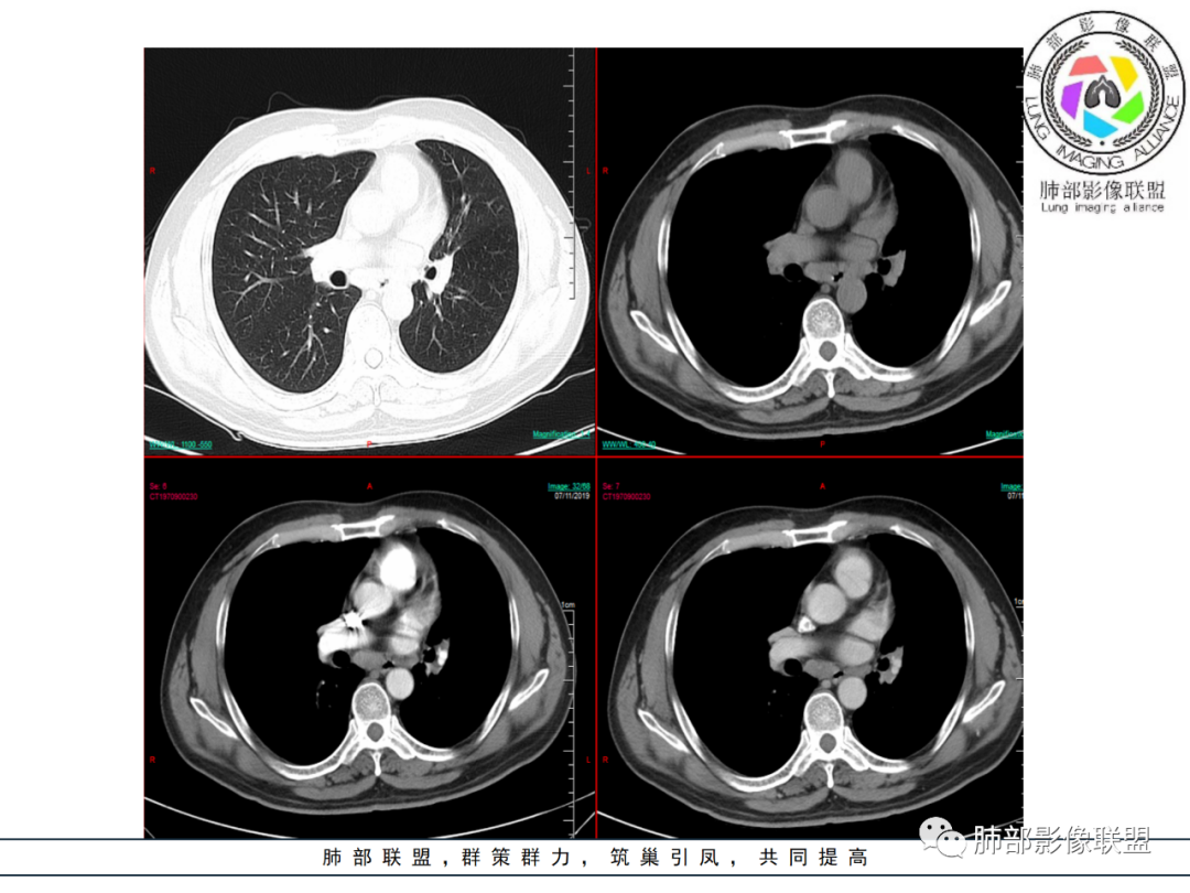【病例】易误诊的肺结核1例CT影像讨论 【病例】易误诊的肺结核1例CT影像讨论