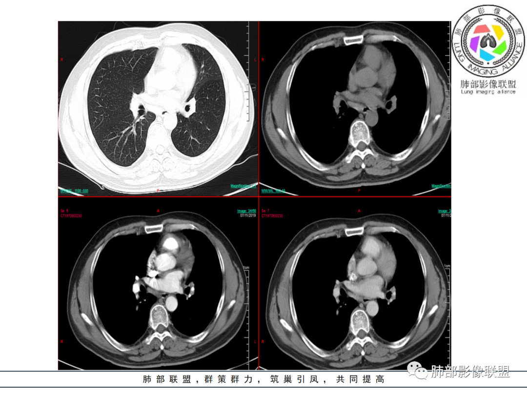 【病例】易误诊的肺结核1例CT影像讨论 【病例】易误诊的肺结核1例CT影像讨论