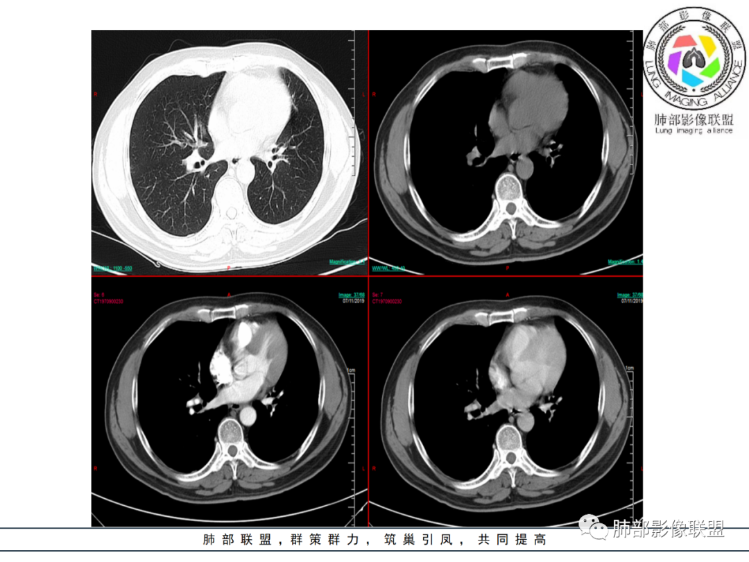 【病例】易误诊的肺结核1例CT影像讨论 【病例】易误诊的肺结核1例CT影像讨论