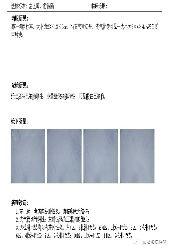 【病例】易误诊的肺结核1例CT影像讨论 【病例】易误诊的肺结核1例CT影像讨论