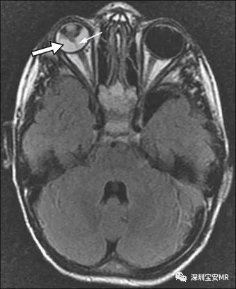 【病例】永存原始玻璃体增生症(PHPV) 一例MR 【病例】永存原始玻璃体增生症(PHPV) 一例MR