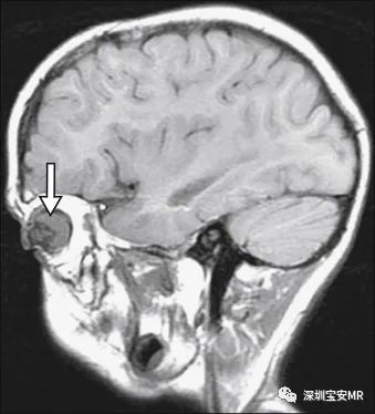 【病例】永存原始玻璃体增生症(PHPV) 一例MR 【病例】永存原始玻璃体增生症(PHPV) 一例MR