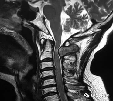 【病例】颈椎结节性筋膜炎1例CT及MR影像 【病例】颈椎结节性筋膜炎1例CT及MR影像