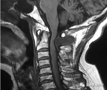 【病例】颈椎结节性筋膜炎1例CT及MR影像 【病例】颈椎结节性筋膜炎1例CT及MR影像