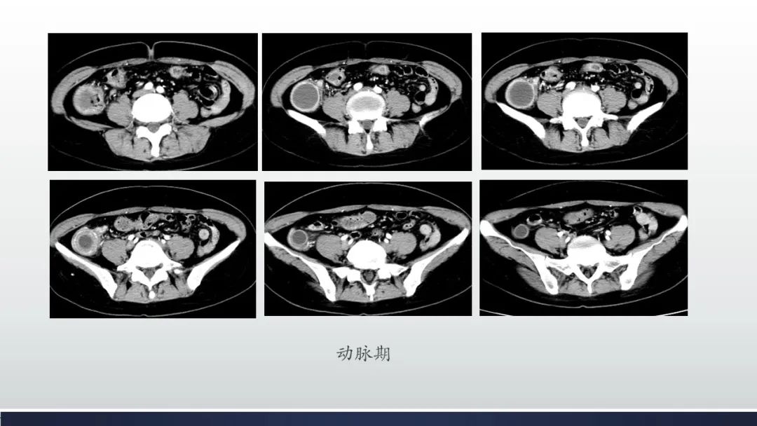 【病例】阑尾低级别粘液性肿瘤1例CT影像 【病例】阑尾低级别粘液性肿瘤1例CT影像