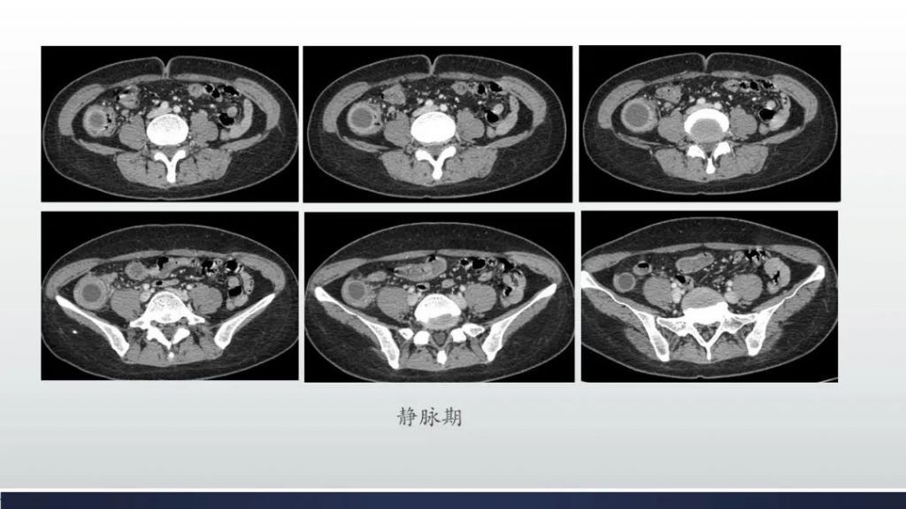 【病例】阑尾低级别粘液性肿瘤1例CT影像
