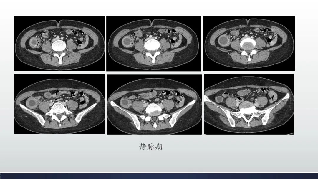 【病例】阑尾低级别粘液性肿瘤1例CT影像 【病例】阑尾低级别粘液性肿瘤1例CT影像