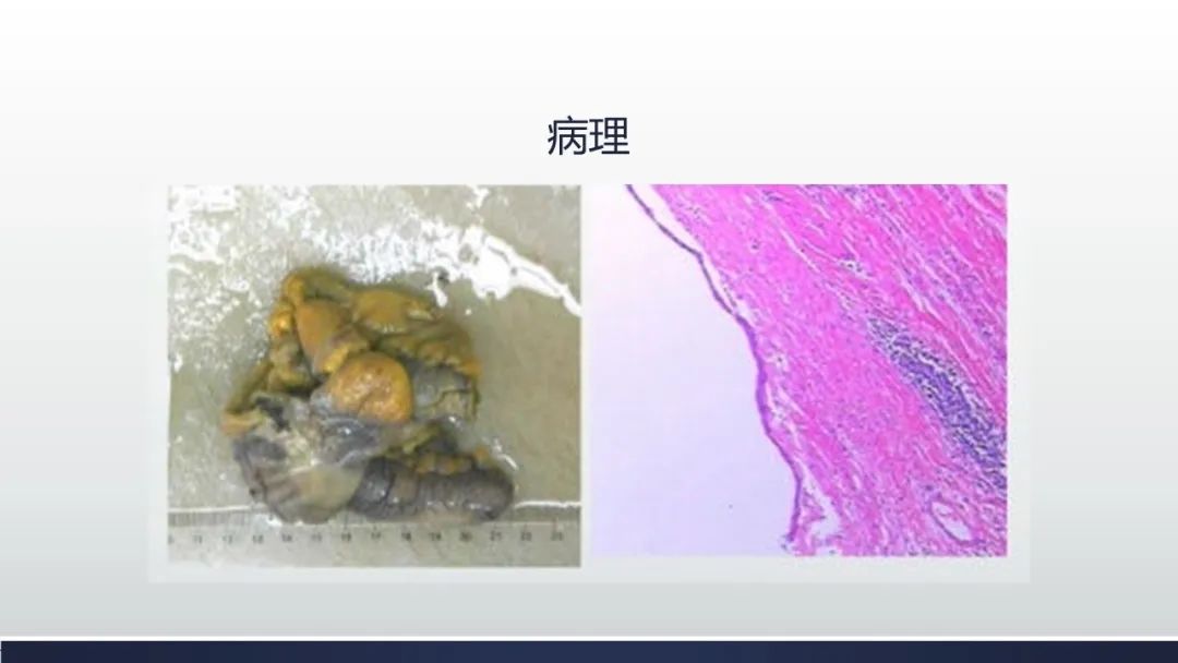 【病例】阑尾低级别粘液性肿瘤1例CT影像 【病例】阑尾低级别粘液性肿瘤1例CT影像