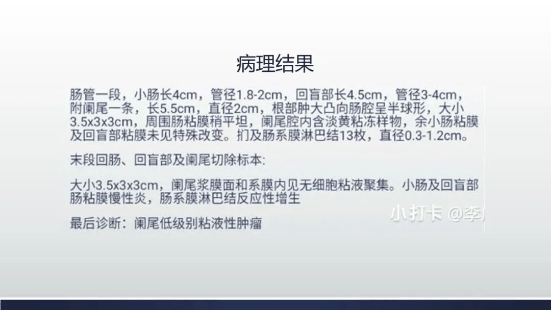 【病例】阑尾低级别粘液性肿瘤1例CT影像 【病例】阑尾低级别粘液性肿瘤1例CT影像