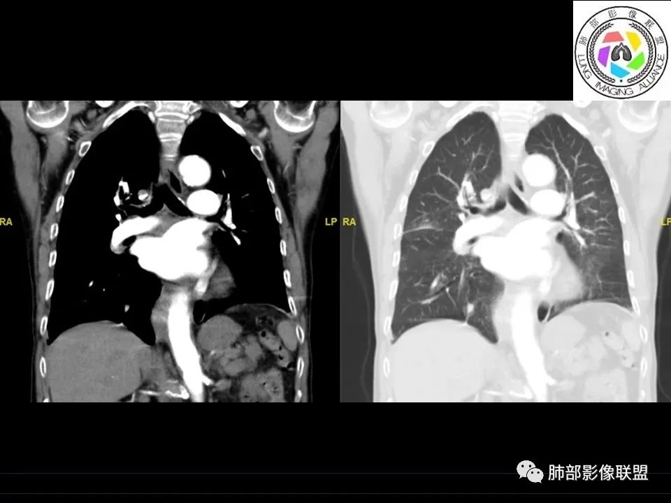 【病例】三明治征”之谜—胸膜淋巴瘤1例CT影像 【病例】三明治征”之谜—胸膜淋巴瘤1例CT影像