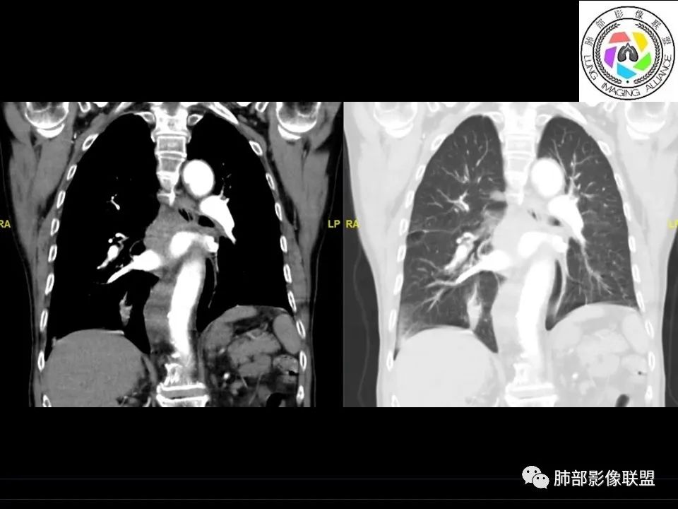 【病例】三明治征”之谜—胸膜淋巴瘤1例CT影像 【病例】三明治征”之谜—胸膜淋巴瘤1例CT影像