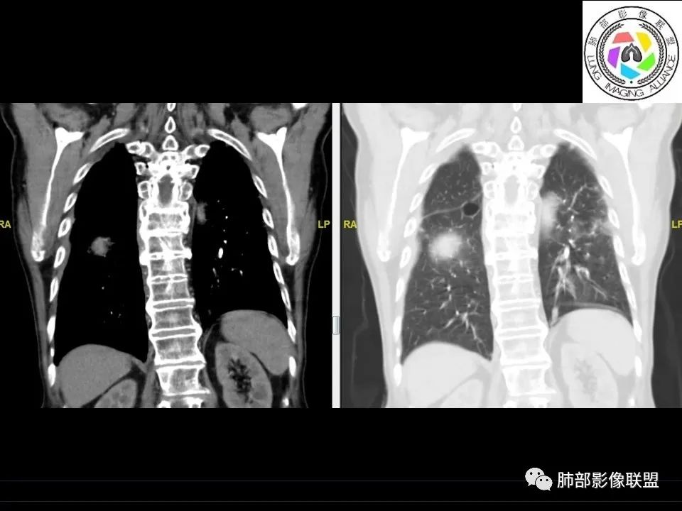 【病例】三明治征”之谜—胸膜淋巴瘤1例CT影像 【病例】三明治征”之谜—胸膜淋巴瘤1例CT影像