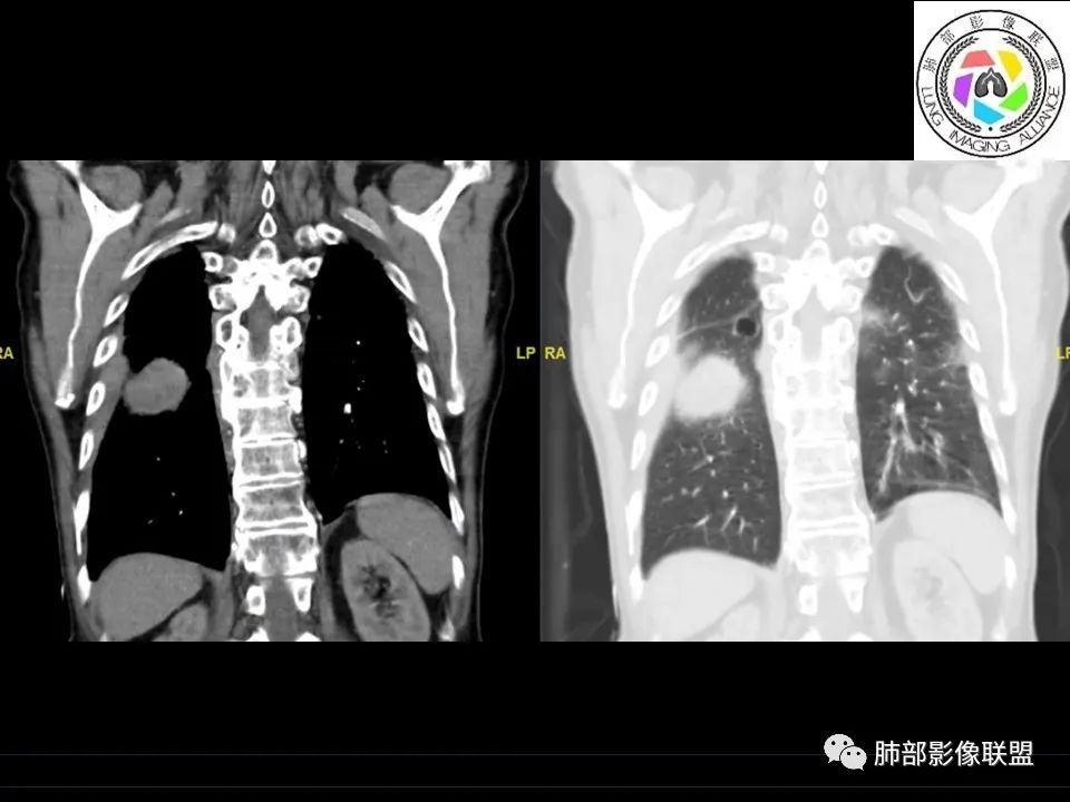 【病例】三明治征”之谜—胸膜淋巴瘤1例CT影像 【病例】三明治征”之谜—胸膜淋巴瘤1例CT影像