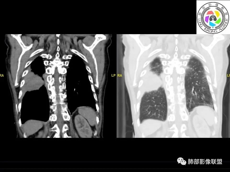 【病例】三明治征”之谜—胸膜淋巴瘤1例CT影像 【病例】三明治征”之谜—胸膜淋巴瘤1例CT影像