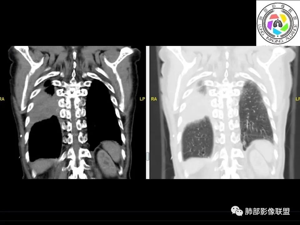 【病例】三明治征”之谜—胸膜淋巴瘤1例CT影像 【病例】三明治征”之谜—胸膜淋巴瘤1例CT影像