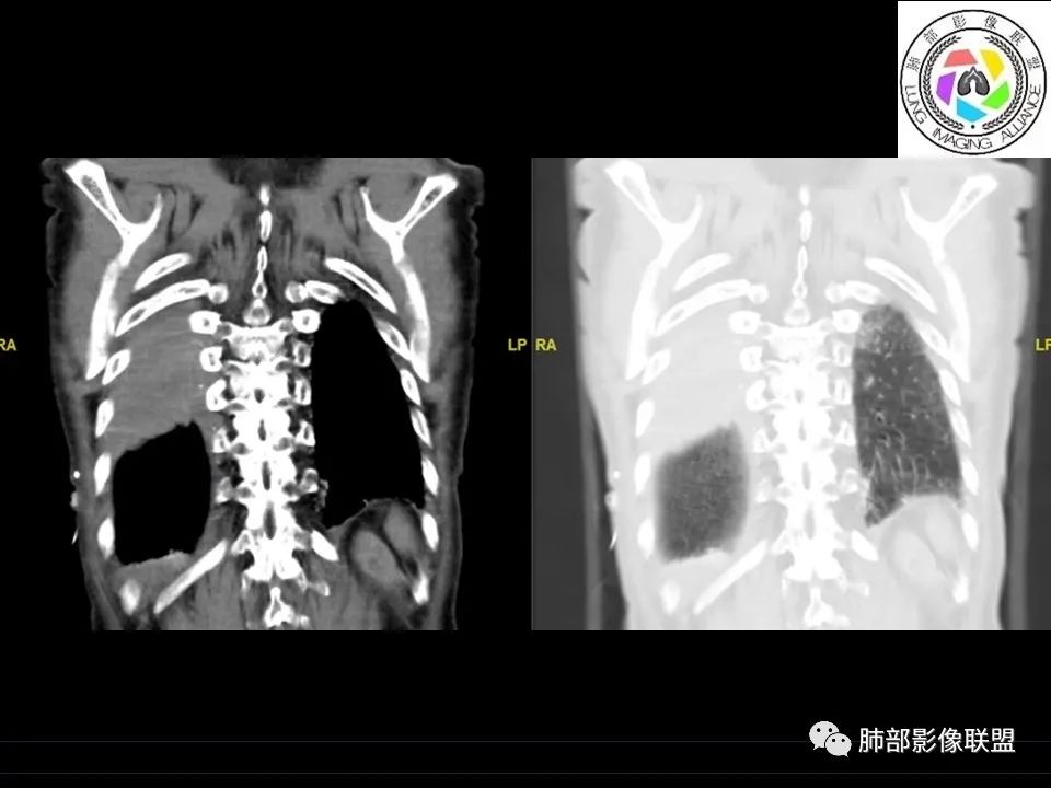 【病例】三明治征”之谜—胸膜淋巴瘤1例CT影像 【病例】三明治征”之谜—胸膜淋巴瘤1例CT影像