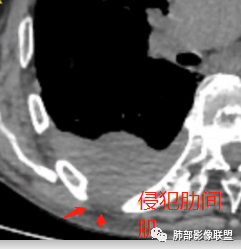 【病例】三明治征”之谜—胸膜淋巴瘤1例CT影像 【病例】三明治征”之谜—胸膜淋巴瘤1例CT影像