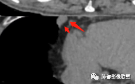 【病例】三明治征”之谜—胸膜淋巴瘤1例CT影像 【病例】三明治征”之谜—胸膜淋巴瘤1例CT影像