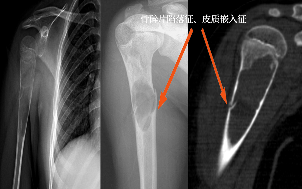 以囊性病灶为主的骨肿瘤及肿瘤样病变影像解析 以囊性病灶为主的骨肿瘤及肿瘤样病变影像解析