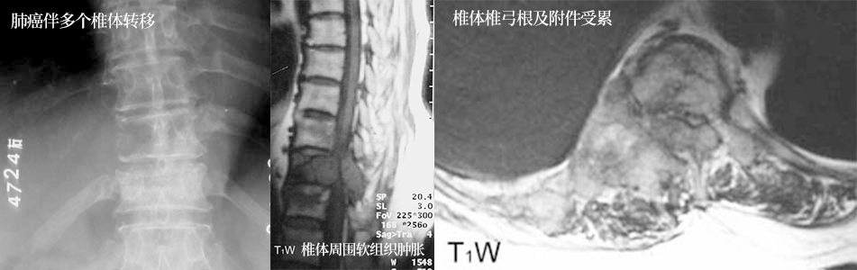以囊性病灶为主的骨肿瘤及肿瘤样病变影像解析 以囊性病灶为主的骨肿瘤及肿瘤样病变影像解析