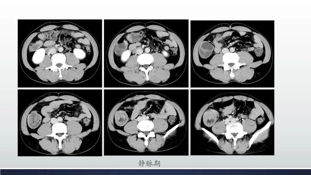 【病例】肠壁海绵状淋巴管瘤伴套叠1例CT 【病例】肠壁海绵状淋巴管瘤伴套叠1例CT