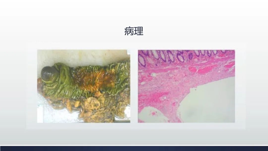 【病例】肠壁海绵状淋巴管瘤伴套叠1例CT 【病例】肠壁海绵状淋巴管瘤伴套叠1例CT