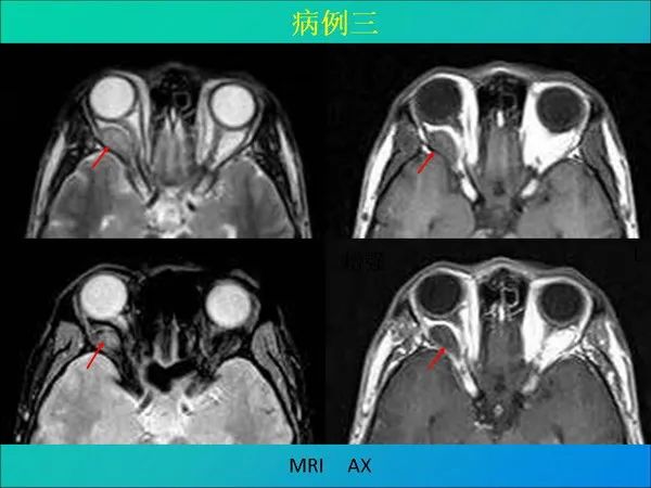 【PPT】常见眶内肿瘤影像诊断与鉴别诊断