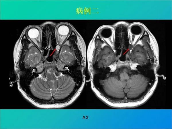 【PPT】常见眶内肿瘤影像诊断与鉴别诊断