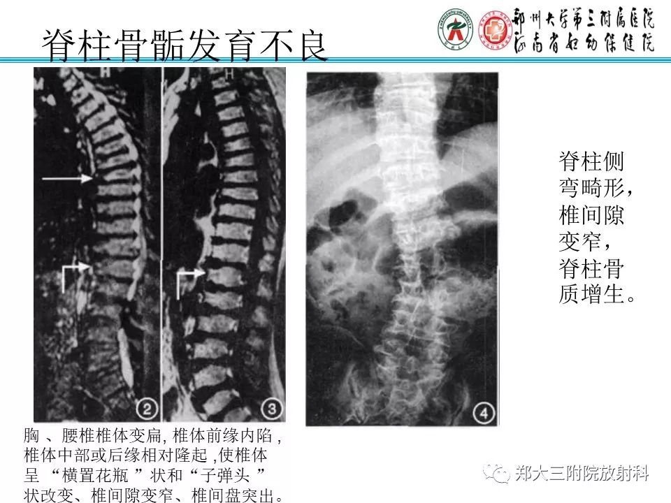 【PPT】儿童先天性骨软骨发育障碍性疾病影像诊断