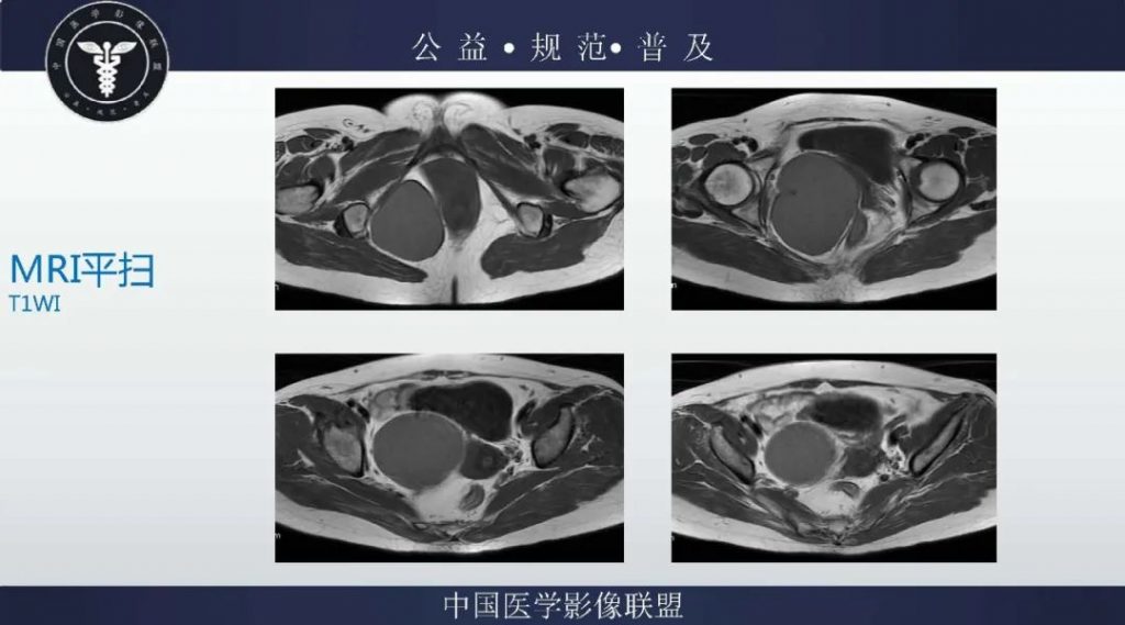 【病例】盆腔皮样囊肿1例MR影像